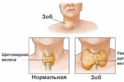 Cambios difusos en la glándula tiroides Cambios difusos en la glándula tiroides en un niño